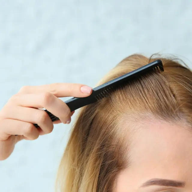 Alopecia Areata